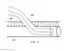 Fig. 17 - Anatomic needle system