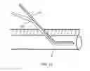 Fig. 18 - Anatomic needle system