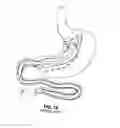 Fig. 02 - Endolumenal esophageal restriction device