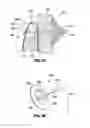 Fig. 07 - Endolumenal esophageal restriction device