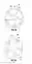 Fig. 11 - Endolumenal esophageal restriction device