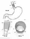 Fig. 13 - Endolumenal esophageal restriction device