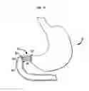 Fig. 18 - SYSTEMS AND METHODS FOR TREATMENT OF OBESITY AND TYPE 2 DIABETES
