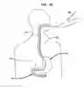 Fig. 28 - SYSTEMS AND METHODS FOR TREATMENT OF OBESITY AND TYPE 2 DIABETES