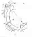 Fig. 02 - Device for applying pressure to bones of arm and method of treatment