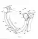 Fig. 03 - Device for applying pressure to bones of arm and method of treatment