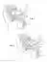 Fig. 05 - Balloon immobilization device for radiation treatment
