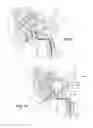 Fig. 06 - Balloon immobilization device for radiation treatment