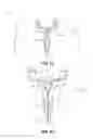 Fig. 12 - Balloon immobilization device for radiation treatment