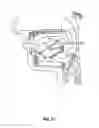 Fig. 20 - SYSTEMS AND METHODS FOR TREATMENT OF SLEEP APNEA