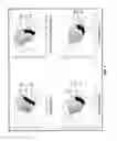 Fig. 03 - Tongue deformation implant