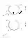 Fig. 12 - Tongue deformation implant