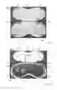 Fig. 30 - THERMAL EYE COMPRESS SYSTEMS AND METHODS OF USE