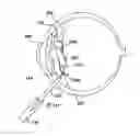 Fig. 01 - INTRAOCULAR LENS FIXATION CORRECTION METHODS AND DEVICES