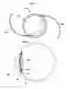 Fig. 02 - INTRAOCULAR LENS FIXATION CORRECTION METHODS AND DEVICES