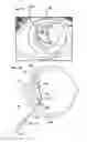 Fig. 03 - INTRAOCULAR LENS FIXATION CORRECTION METHODS AND DEVICES