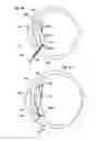 Fig. 04 - INTRAOCULAR LENS FIXATION CORRECTION METHODS AND DEVICES