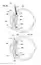 Fig. 05 - INTRAOCULAR LENS FIXATION CORRECTION METHODS AND DEVICES