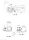 Fig. 12 - INTRAOCULAR LENS FIXATION CORRECTION METHODS AND DEVICES