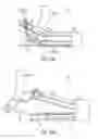 Fig. 18 - INTRAOCULAR LENS FIXATION CORRECTION METHODS AND DEVICES