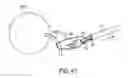 Fig. 23 - INTRAOCULAR LENS FIXATION CORRECTION METHODS AND DEVICES