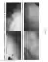 Fig. 12 - Minced Cartilage Systems and Methods