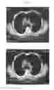 Fig. 04 - A METHOD FOR TREATING TUMOR BY USING RECOMBINANT INTERFERON WITH CHANGED SPATIAL CONFIGURATION
