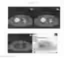 Fig. 05 - A METHOD FOR TREATING TUMOR BY USING RECOMBINANT INTERFERON WITH CHANGED SPATIAL CONFIGURATION