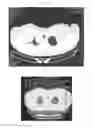 Fig. 06 - A METHOD FOR TREATING TUMOR BY USING RECOMBINANT INTERFERON WITH CHANGED SPATIAL CONFIGURATION