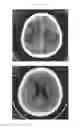 Fig. 07 - A METHOD FOR TREATING TUMOR BY USING RECOMBINANT INTERFERON WITH CHANGED SPATIAL CONFIGURATION