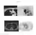Fig. 10 - A METHOD FOR TREATING TUMOR BY USING RECOMBINANT INTERFERON WITH CHANGED SPATIAL CONFIGURATION