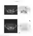 Fig. 12 - A METHOD FOR TREATING TUMOR BY USING RECOMBINANT INTERFERON WITH CHANGED SPATIAL CONFIGURATION