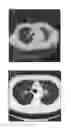 Fig. 13 - A METHOD FOR TREATING TUMOR BY USING RECOMBINANT INTERFERON WITH CHANGED SPATIAL CONFIGURATION