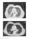 Fig. 15 - A METHOD FOR TREATING TUMOR BY USING RECOMBINANT INTERFERON WITH CHANGED SPATIAL CONFIGURATION