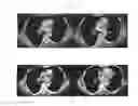 Fig. 18 - A METHOD FOR TREATING TUMOR BY USING RECOMBINANT INTERFERON WITH CHANGED SPATIAL CONFIGURATION