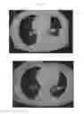 Fig. 20 - A METHOD FOR TREATING TUMOR BY USING RECOMBINANT INTERFERON WITH CHANGED SPATIAL CONFIGURATION