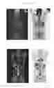 Fig. 22 - A METHOD FOR TREATING TUMOR BY USING RECOMBINANT INTERFERON WITH CHANGED SPATIAL CONFIGURATION