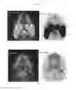 Fig. 23 - A METHOD FOR TREATING TUMOR BY USING RECOMBINANT INTERFERON WITH CHANGED SPATIAL CONFIGURATION