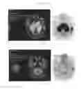 Fig. 24 - A METHOD FOR TREATING TUMOR BY USING RECOMBINANT INTERFERON WITH CHANGED SPATIAL CONFIGURATION