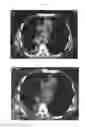 Fig. 25 - A METHOD FOR TREATING TUMOR BY USING RECOMBINANT INTERFERON WITH CHANGED SPATIAL CONFIGURATION