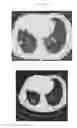 Fig. 26 - A METHOD FOR TREATING TUMOR BY USING RECOMBINANT INTERFERON WITH CHANGED SPATIAL CONFIGURATION