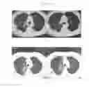 Fig. 27 - A METHOD FOR TREATING TUMOR BY USING RECOMBINANT INTERFERON WITH CHANGED SPATIAL CONFIGURATION
