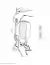 Fig. 60 - Negative pressure wound closure device and systems and methods of use in treating wounds with negative pressure