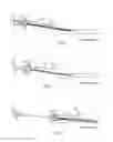 Fig. 03 - Method involving use of an assembled indwelling assembly
