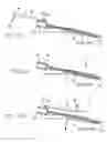 Fig. 04 - Method involving use of an assembled indwelling assembly