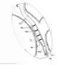 Fig. 01 - Device and Method for the Ablation of Fibrin Sheath Formation on a Venous Catheter