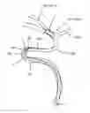 Fig. 01 - System and methods for intracranial vessel access