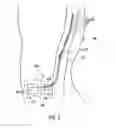 Fig. 03 - Methods of shielding implantable medical leads and implantable medical lead extensions