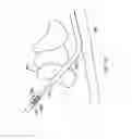 Fig. 14 - Methods of shielding implantable medical leads and implantable medical lead extensions