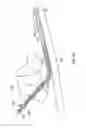 Fig. 16 - Methods of shielding implantable medical leads and implantable medical lead extensions